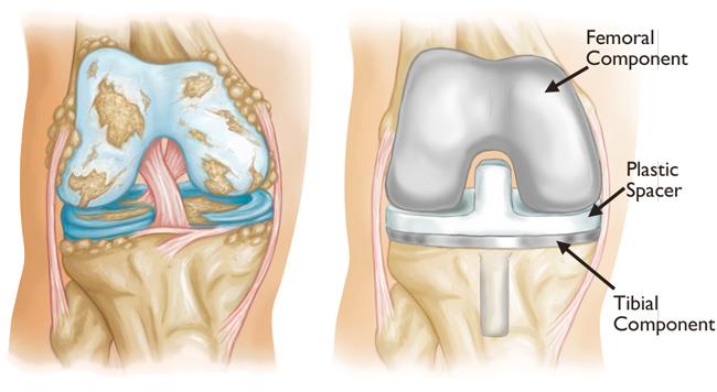 total knee replacement